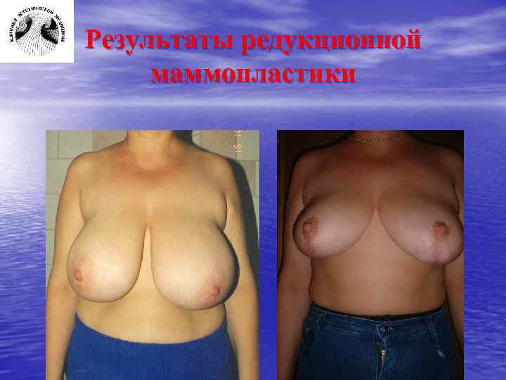 Результаты редукционной маммопластики 