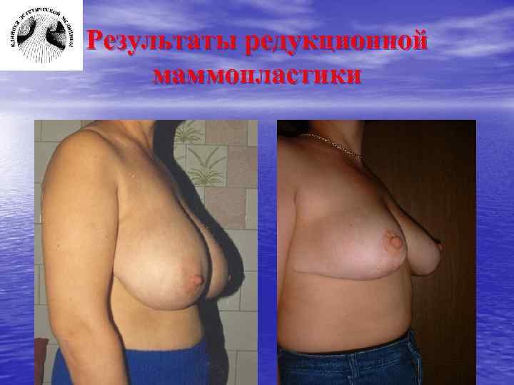 Результаты редукционной маммопластики 