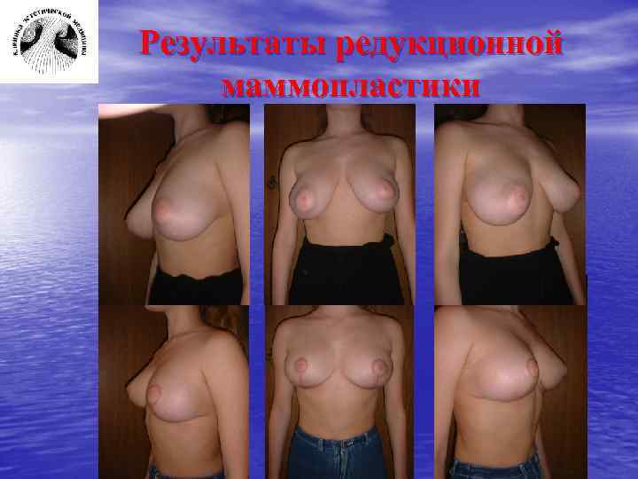 Результаты редукционной маммопластики 
