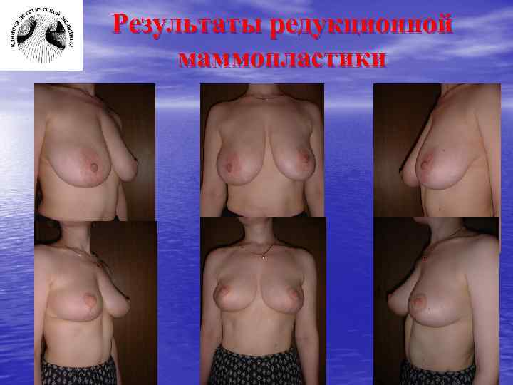 Результаты редукционной маммопластики 