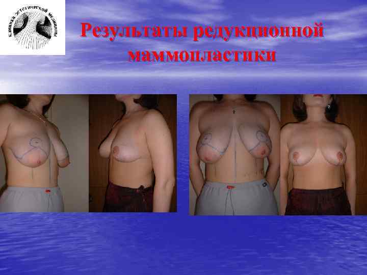 Результаты редукционной маммопластики 