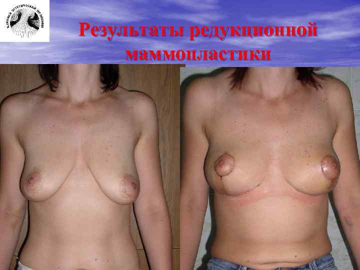 Результаты редукционной маммопластики 