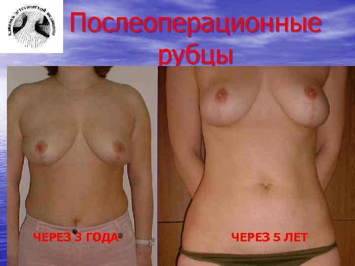 Послеоперационные рубцы ЧЕРЕЗ 3 ГОДА ЧЕРЕЗ 5 ЛЕТ 