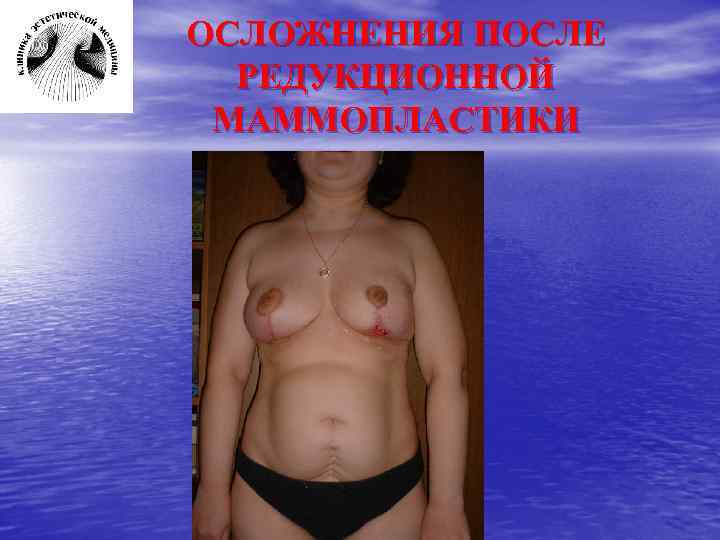 ОСЛОЖНЕНИЯ ПОСЛЕ РЕДУКЦИОННОЙ МАММОПЛАСТИКИ 