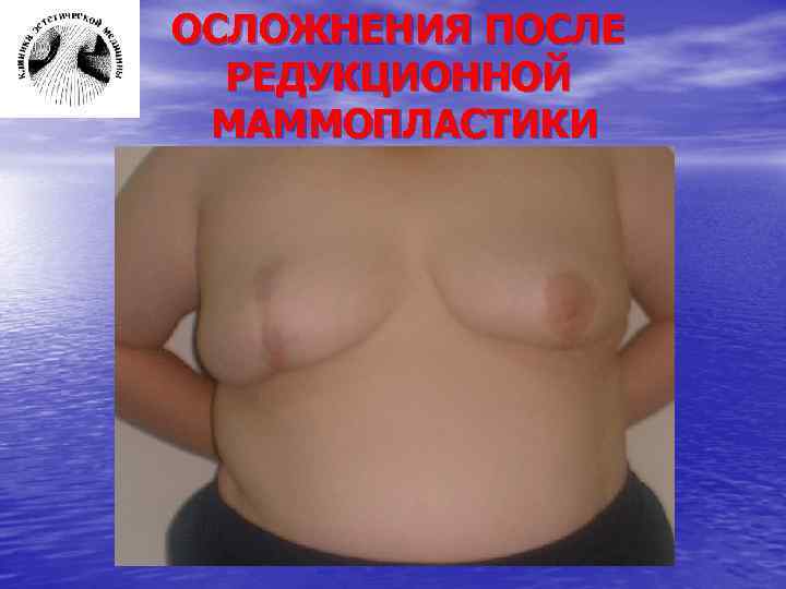 ОСЛОЖНЕНИЯ ПОСЛЕ РЕДУКЦИОННОЙ МАММОПЛАСТИКИ 