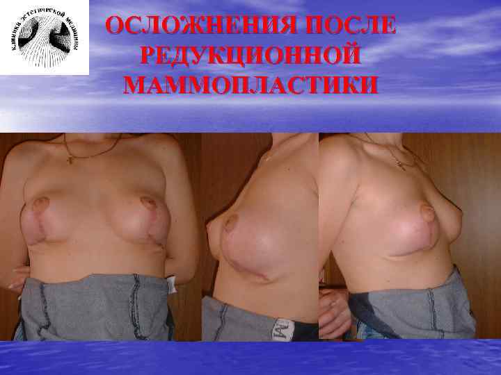 ОСЛОЖНЕНИЯ ПОСЛЕ РЕДУКЦИОННОЙ МАММОПЛАСТИКИ 