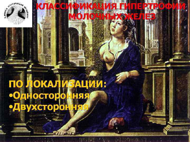КЛАССИФИКАЦИЯ ГИПЕРТРОФИИ МОЛОЧНЫХ ЖЕЛЕЗ ПО ЛОКАЛИЗАЦИИ: • Односторонняя • Двухсторонняя 