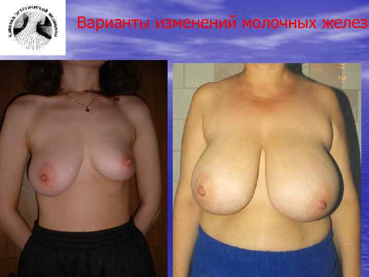 Варианты изменений молочных желез 