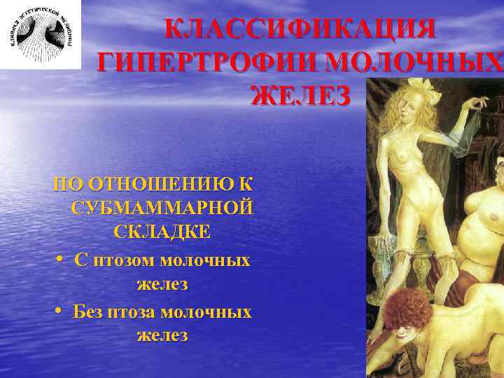 КЛАССИФИКАЦИЯ ГИПЕРТРОФИИ МОЛОЧНЫХ ЖЕЛЕЗ ПО ОТНОШЕНИЮ К СУБМАММАРНОЙ СКЛАДКЕ • С птозом молочных желез