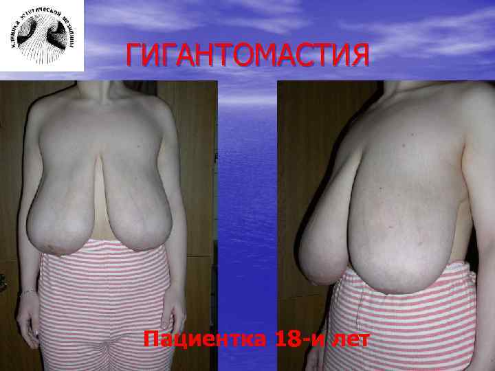 ГИГАНТОМАСТИЯ Пациентка 18 -и лет 