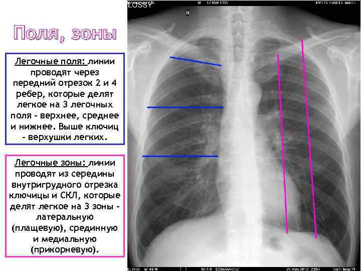 Поля, зоны Легочные поля: линии проводят через передний отрезок 2 и 4 ребер, которые
