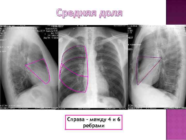 Средняя доля Справа – между 4 и 6 ребрами 