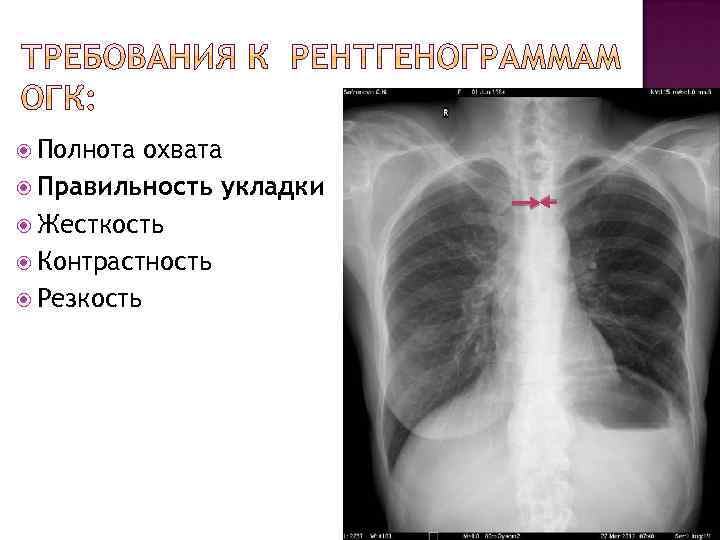  Полнота охвата Правильность укладки Жесткость Контрастность Резкость 