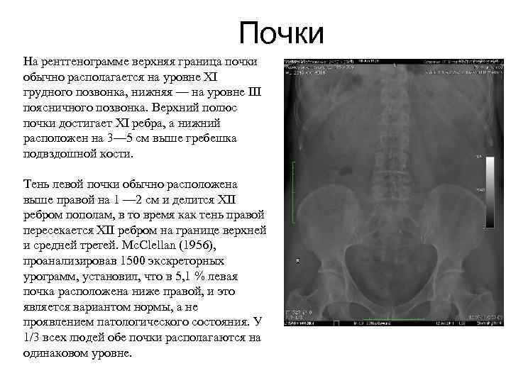 Почки На рентгенограмме верхняя граница почки обычно располагается на уровне XI грудного позвонка, нижняя