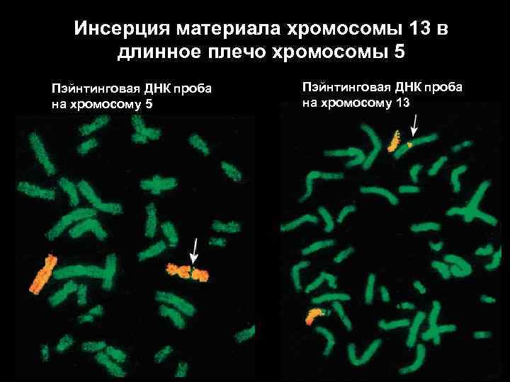 Хромосомные болезни фото