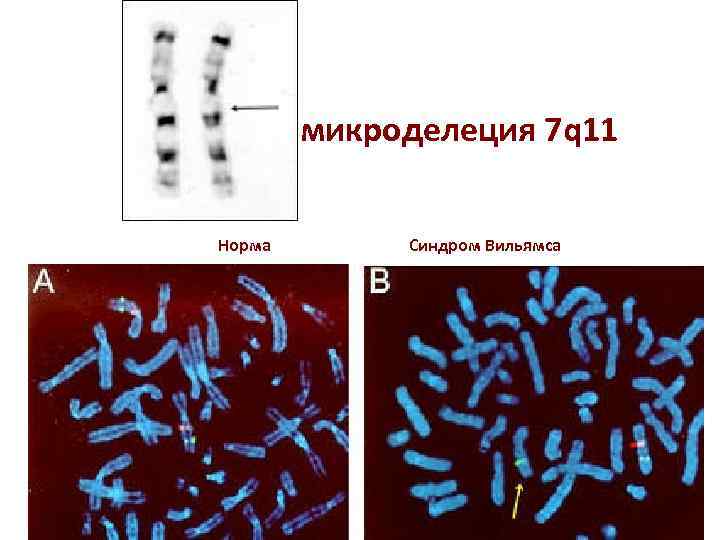 микроделеция 7 q 11 Норма Синдром Вильямса 