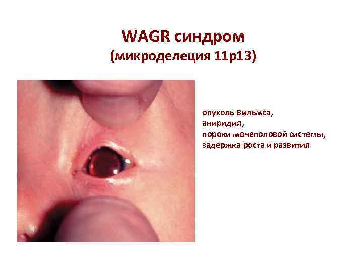 WAGR синдром (микроделеция 11 р13) опухоль Вильмса, аниридия, пороки мочеполовой системы, задержка роста и