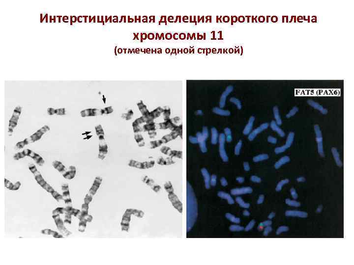 Интерстициальная делеция короткого плеча хромосомы 11 (отмечена одной стрелкой) 