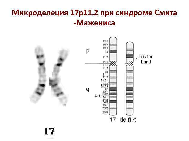 Микроделеция 17 p 11. 2 при синдроме Смита -Мажениса 