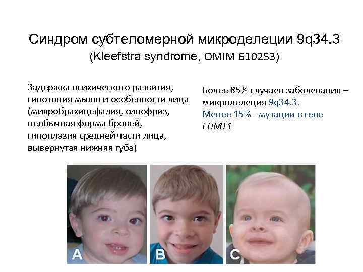 Синдром субтеломерной микроделеции 9 q 34. 3 (Kleefstra syndrome, OMIM 610253) Задержка психического развития,