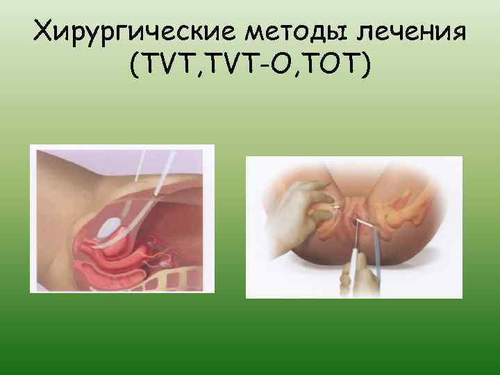 Хирургические методы лечения (TVT, TVT-O, TOT) 