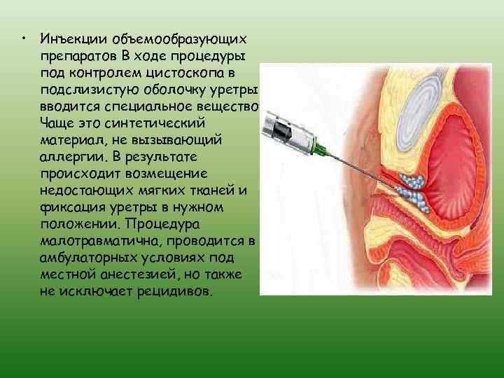  • Инъекции объемообразующих препаратов В ходе процедуры под контролем цистоскопа в подслизистую оболочку