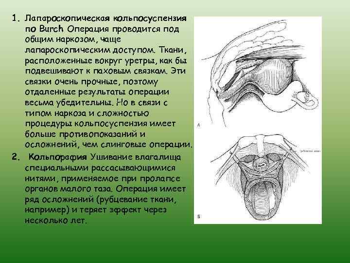 1. Лапароскопическая кольпосуспензия по Burch Операция проводится под общим наркозом, чаще лапароскопическим доступом. Ткани,