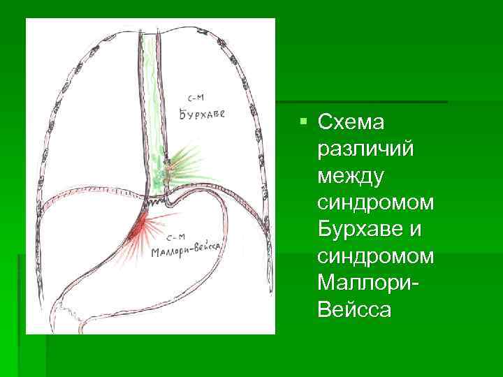 § Схема различий между синдромом Бурхаве и синдромом Маллори. Вейсса 