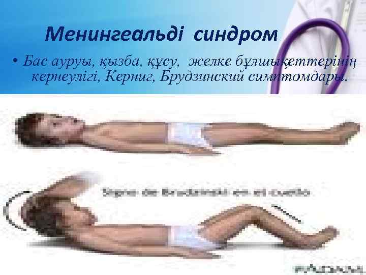 Менингеальді синдром • Бас ауруы, қызба, құсу, желке бұлшықеттерінің кернеулігі, Керниг, Брудзинский симптомдары. 