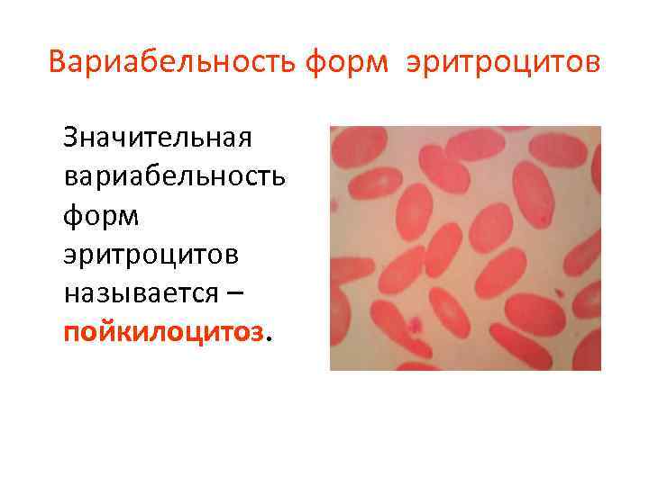 Вариабельность форм эритроцитов Значительная вариабельность форм эритроцитов называется – пойкилоцитоз. 