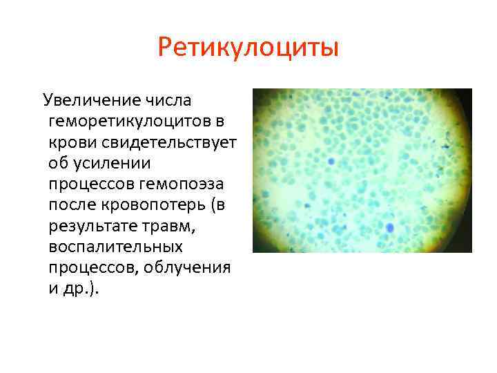 Ретикулоциты Увеличение числа геморетикулоцитов в крови свидетельствует об усилении процессов гемопоэза после кровопотерь (в