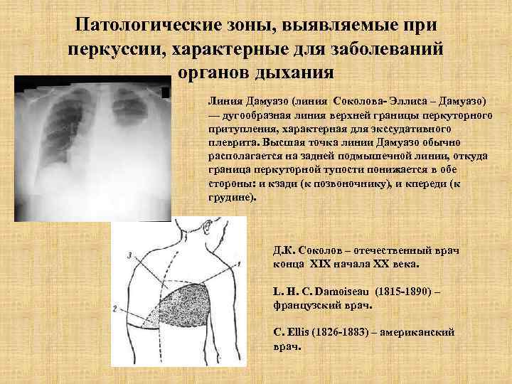 Патологические зоны, выявляемые при перкуссии, характерные для заболеваний органов дыхания Линия Дамуазо (линия Соколова-