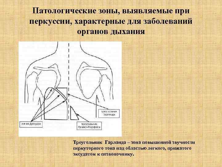 Патологические зоны, выявляемые при перкуссии, характерные для заболеваний органов дыхания Треугольник Гарланда – зона