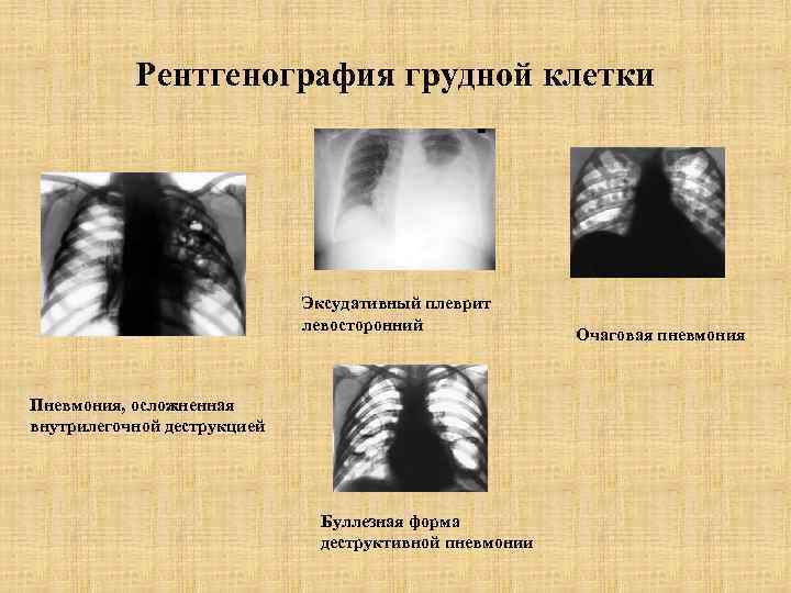 Рентгенография грудной клетки Эксудативный плеврит левосторонний Пневмония, осложненная внутрилегочной деструкцией Буллезная форма деструктивной пневмонии