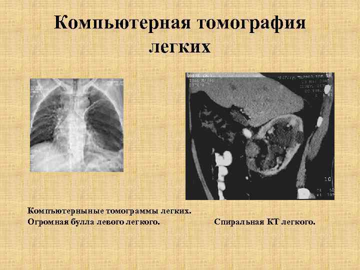 Компьютерная томография легких Компъютерныные томограммы легких. Огромная булла левого легкого. Спиральная КТ легкого. 