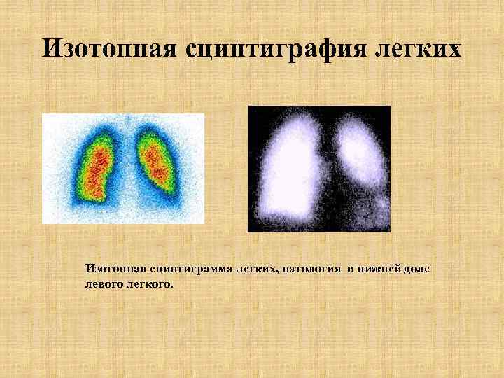 Изотопная сцинтиграфия легких Изотопная сцинтиграмма легких, патология в нижней доле левого легкого. 