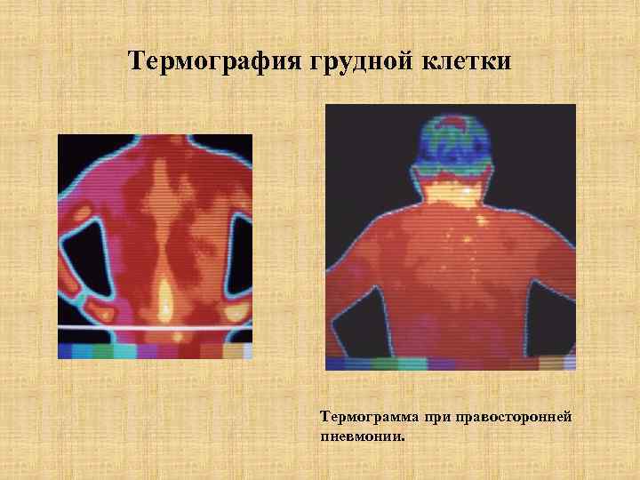 Термография грудной клетки Термограмма при правосторонней пневмонии. 