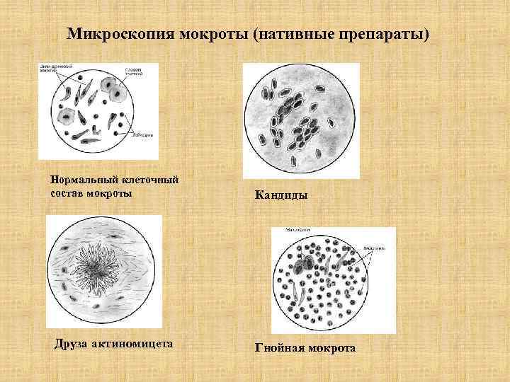 Микроскопия мокроты (нативные препараты) Нормальный клеточный состав мокроты Друза актиномицета Кандиды Гнойная мокрота 