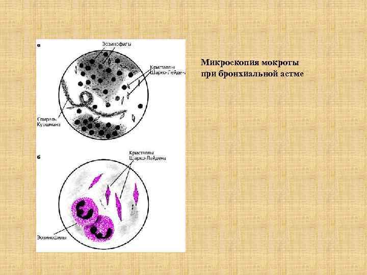 Микроскопия мокроты при бронхиальной астме 