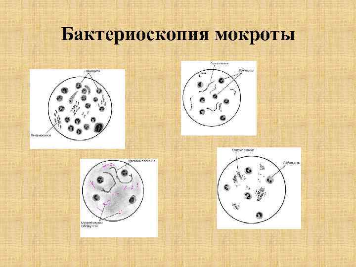 Бактериоскопия мокроты 