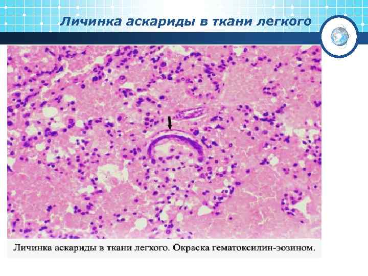 Личинка аскариды в ткани легкого 