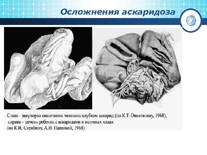 Осложнения аскаридоза 