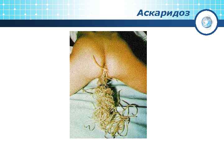 Аскаридоз 