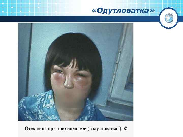  «Одутловатка» 