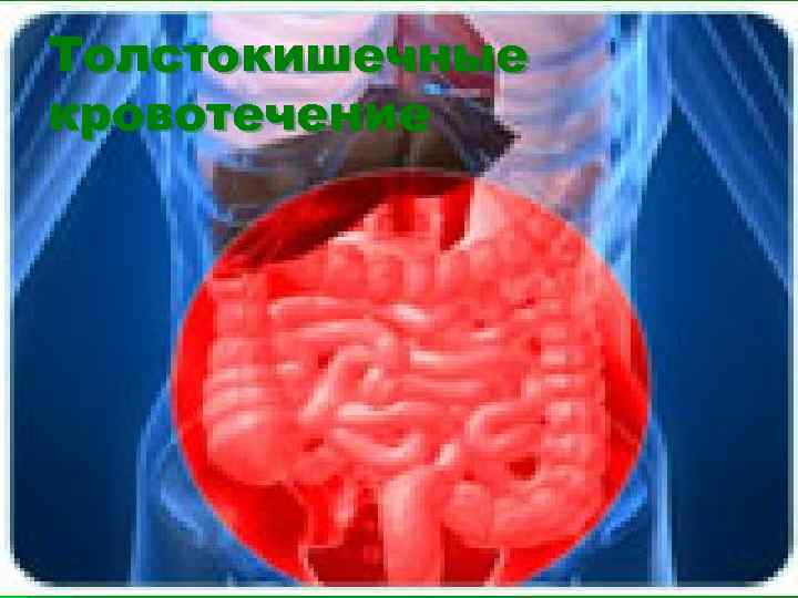 Толстокишечные кровотечение 