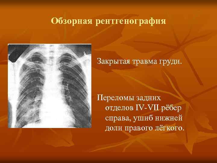 Обзорная рентгенография Закрытая травма груди. Переломы задних отделов IV-VII рёбер справа, ушиб нижней доли