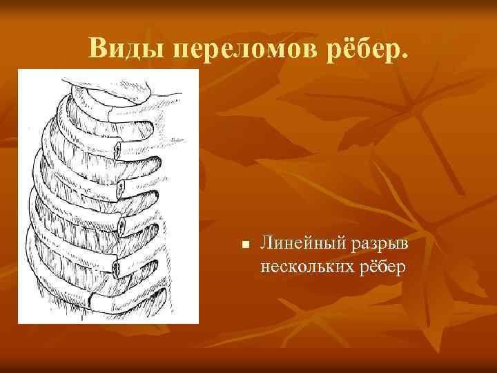 Виды переломов рёбер. n Линейный разрыв нескольких рёбер 