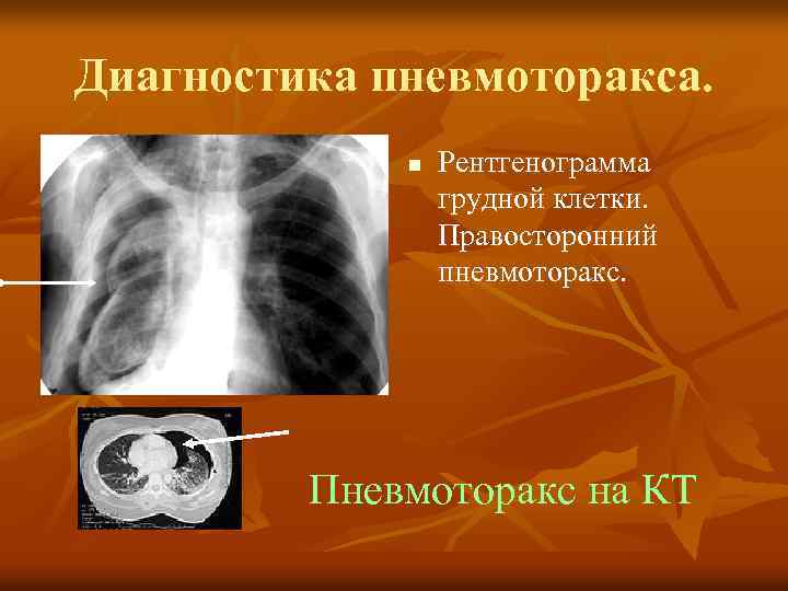 Диагностика пневмоторакса. n Рентгенограмма грудной клетки. Правосторонний пневмоторакс. Пневмоторакс на КТ 