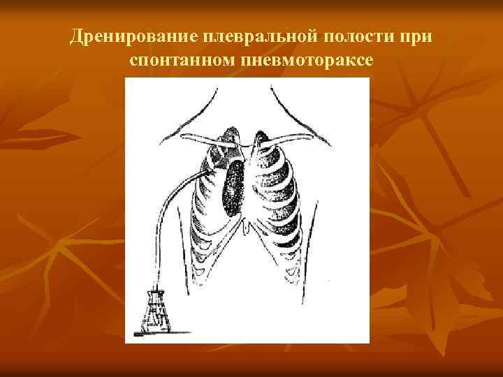 Дренирование плевральной полости при спонтанном пневмотораксе 