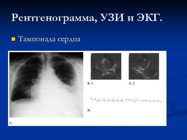 Рентгенограмма, УЗИ и ЭКГ. n Тампонада сердца 